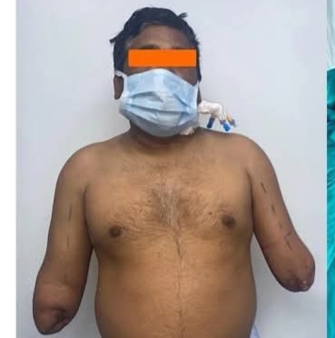 A 45 YEAR OLD PAINTER, RAJ KUMAR LOST BOTH&nbsp;HANDS