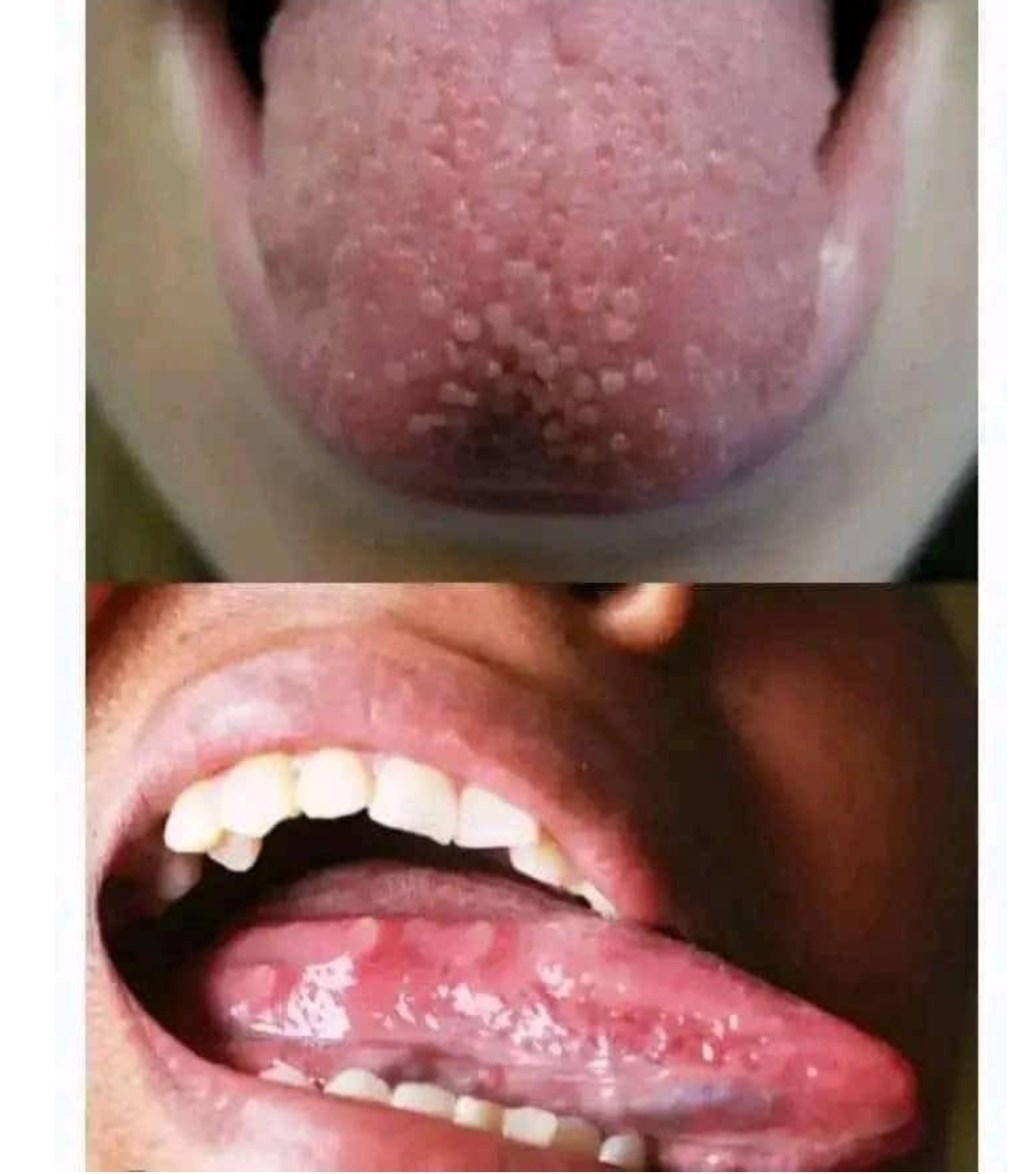 If you have pimples on your tongue, your body is warning you about something very&nbsp;important